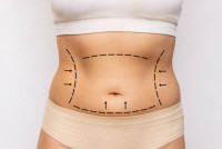 Best Liposuction in Riyadh