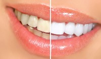 WHEN CAN I GET MY TEETH BLEACHING PROCEDURE DONE?