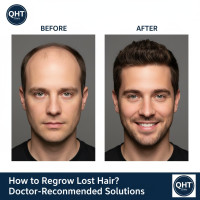 Natural Hair Restoration with Hair Transplant in Hyderabad