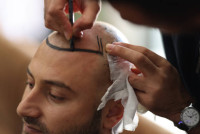 Hair Transplant in Riyadh