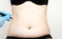 Liposuction in Riyadh