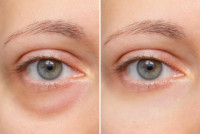 EyeLid Surgery in Riyadh