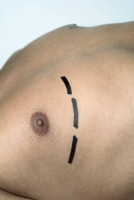 Gynecomastia Surgery in Riyadh