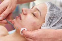 Best acne treatment in islamabad