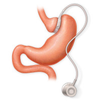 lap band melbourne - Complete Weight Loss Solution