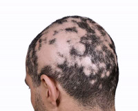 ALOPECIA AREATA TREATMENT COST IN DUBAI AND UAE