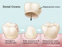 Custom Dental Crowns for Stronger, Natural-Looking Teeth