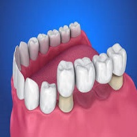 Affordable Dental Bridges Treatment In Usa