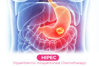 Cost of Hyperthermic Intraoperative Peritoneal Chemotherapy India