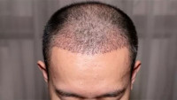 Hair transplant surgery