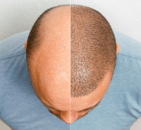Hair transplant in Riyadh