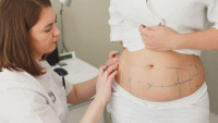 Laser Liposuction in Riyadh