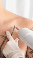Laser Tattoo Removal