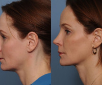 Are You Looking For Facetite Surgery In Coral Gables