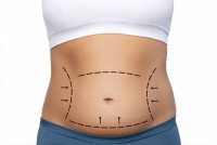 Top Risks and Complications of Lipo Abdominoplasty Surgery