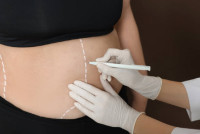 Liposuction in Riyadh