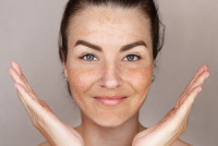 Best Melasma treatment in Islamabad Pakistan