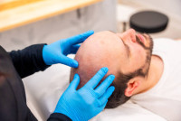 PRP hair treatment in Riyadh