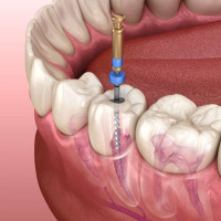 Root Canal in Dubai (Endodontic)