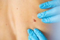 Skin Tag Removal in Riyadh
