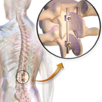 Affordable Spinal Fusion Surgery India