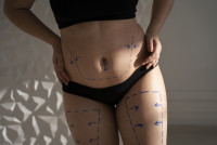 Tummy Tuck surgery in Riyadh