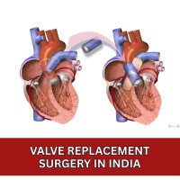 Cost of Valve Replacement Surgery India