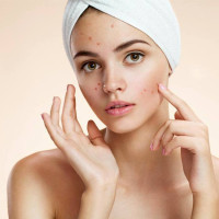 Acne Treatment In Chennai