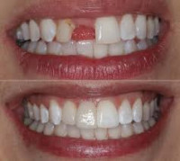 Bridges & Crowns Dental Solutions Islamabad