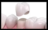 Dental Implants Sherman Oaks