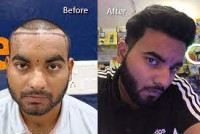 Hair transplant in Rohini