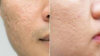 Acne Scars treatment