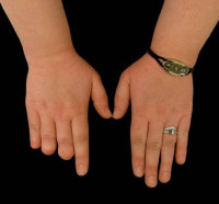 Custom Finger Prosthetics, Thumb Prosthetics, and Hand & Partial Arm Prosthetics