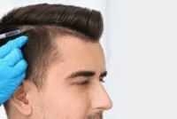 Hair Transplant in Riyadh