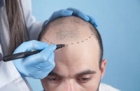 Hair Transplant in Riyadh