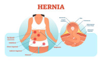 Hernia Treatments in Queens