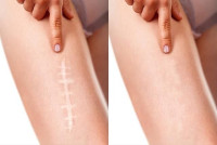 Skin and Scar Rejuvenation
