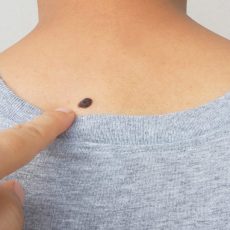 Skin Lesions Removal Abu Dhabi