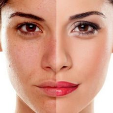 Microdermabrasion Treatment in Sharjah